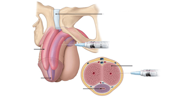 Injection of your own fatty tissue to increase penis thickness